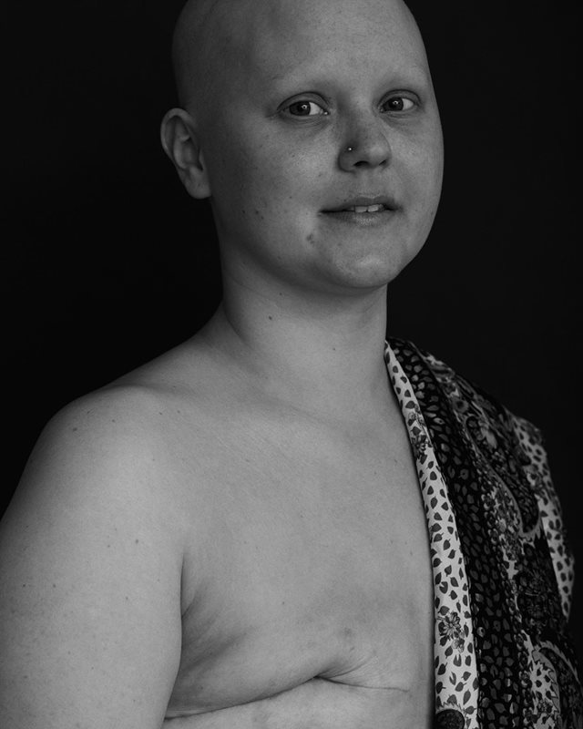 Georgia Devey Smith After my mastectomy